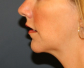 Feel Beautiful - Chin Implant 206 - After Photo